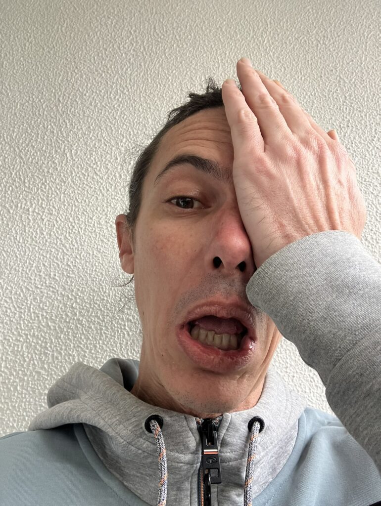 brulure piments forts